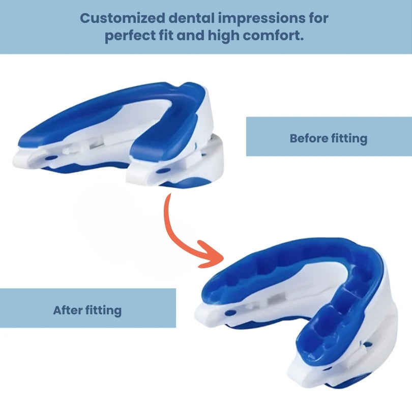 Anti-Snoring & Jaw Advancement Mouthguard – SilentSleep™
