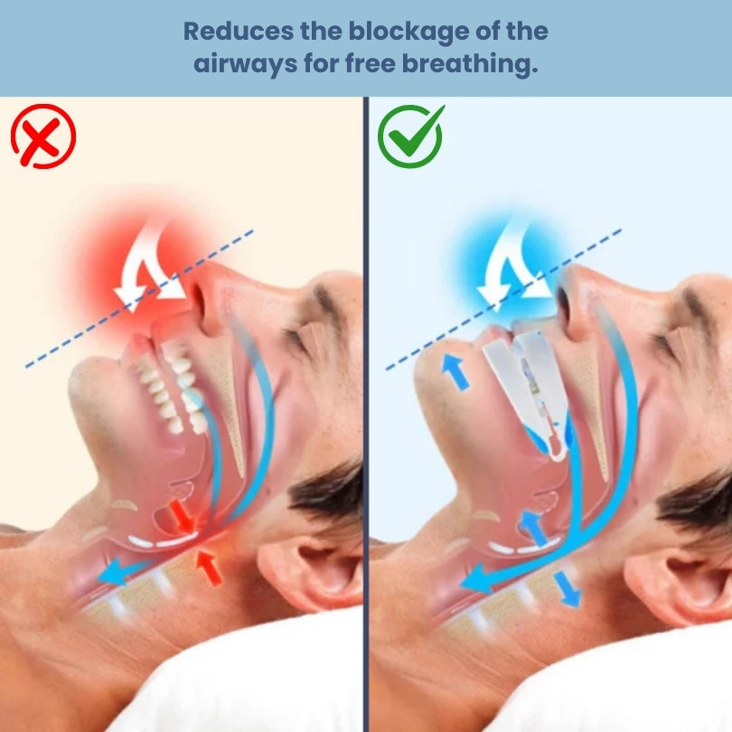 Anti-Snoring & Jaw Advancement Mouthguard – SilentSleep™