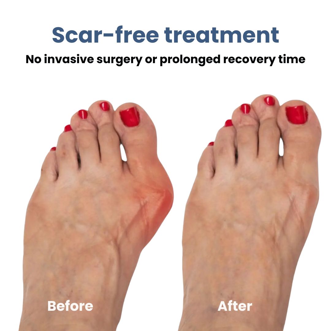 Aussie Care Pro – Hallux Corrector Brace