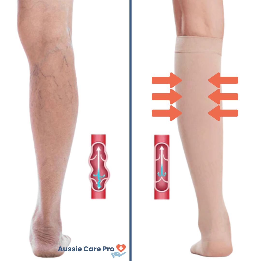 Aussie Care Pro Compression Socks – Open Toe Support for Better Circulation
