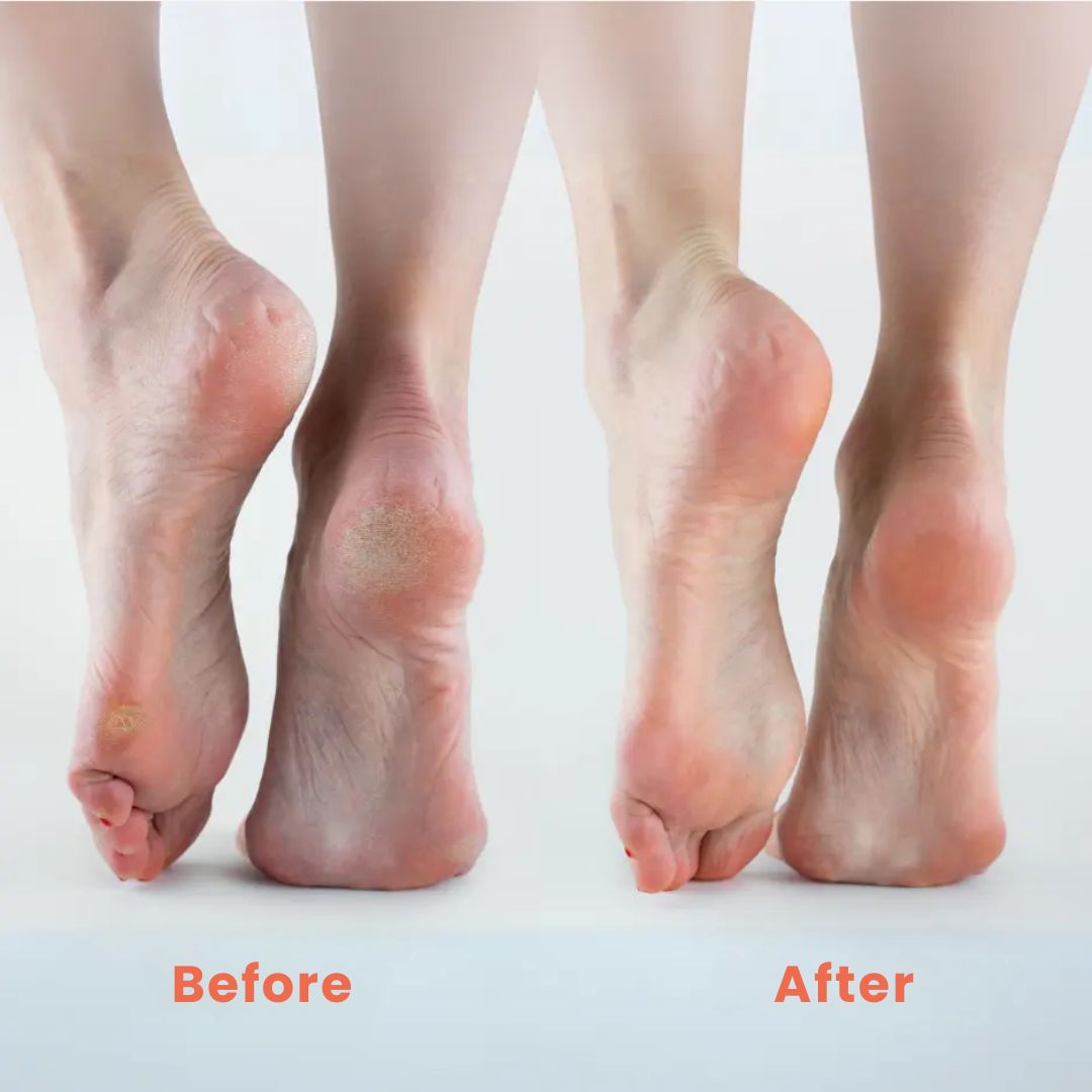 Aussie Care Pro Electric Callus Remover
