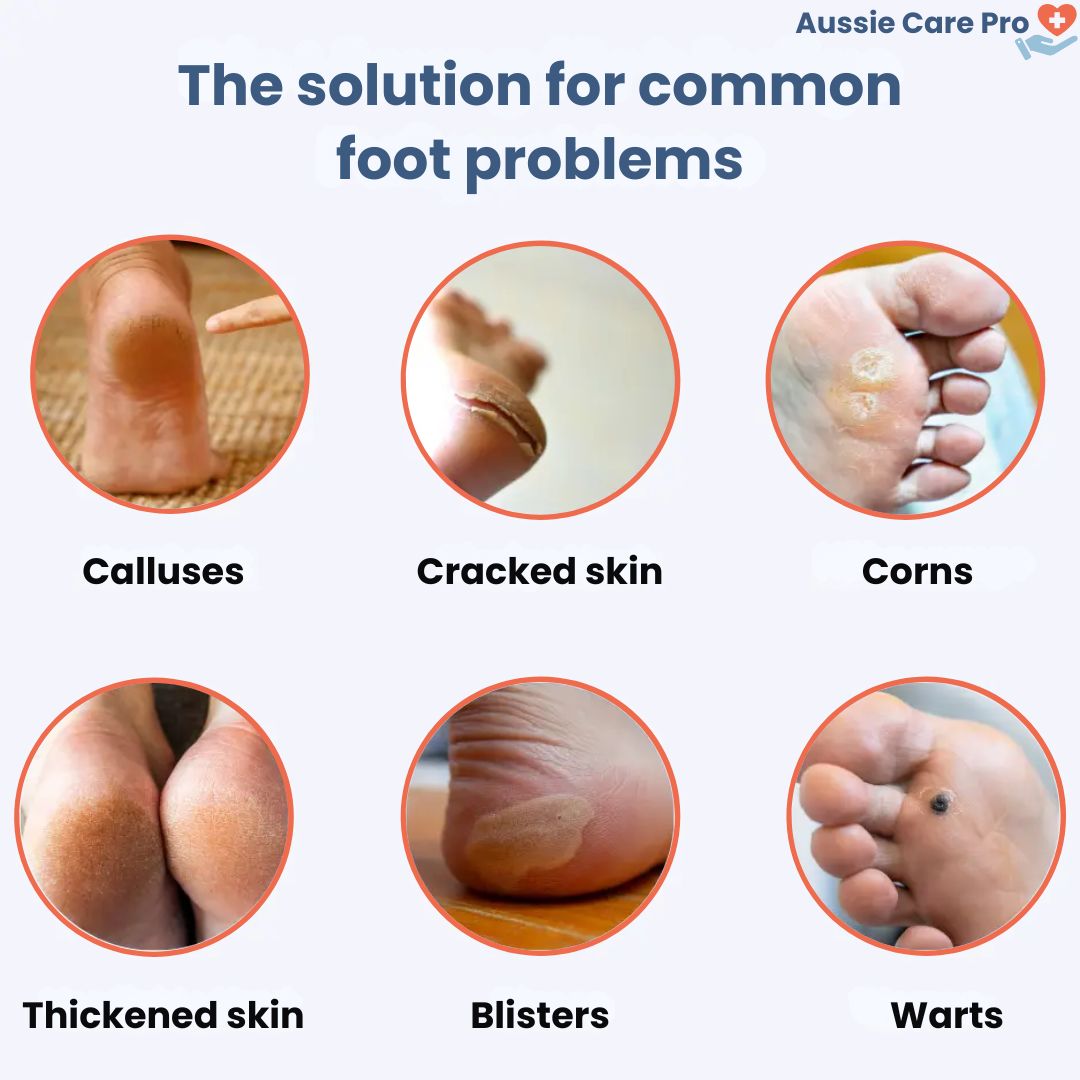 Aussie Care Pro Electric Callus Remover