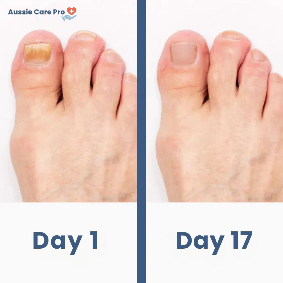 NailCare Laser Nail Fungus Treatment – Safe & Chemical-Free Therapy