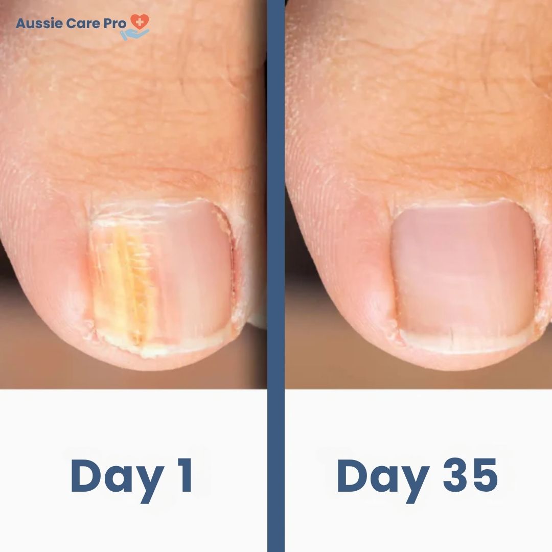 NailCare Laser Nail Fungus Treatment – Safe & Chemical-Free Therapy
