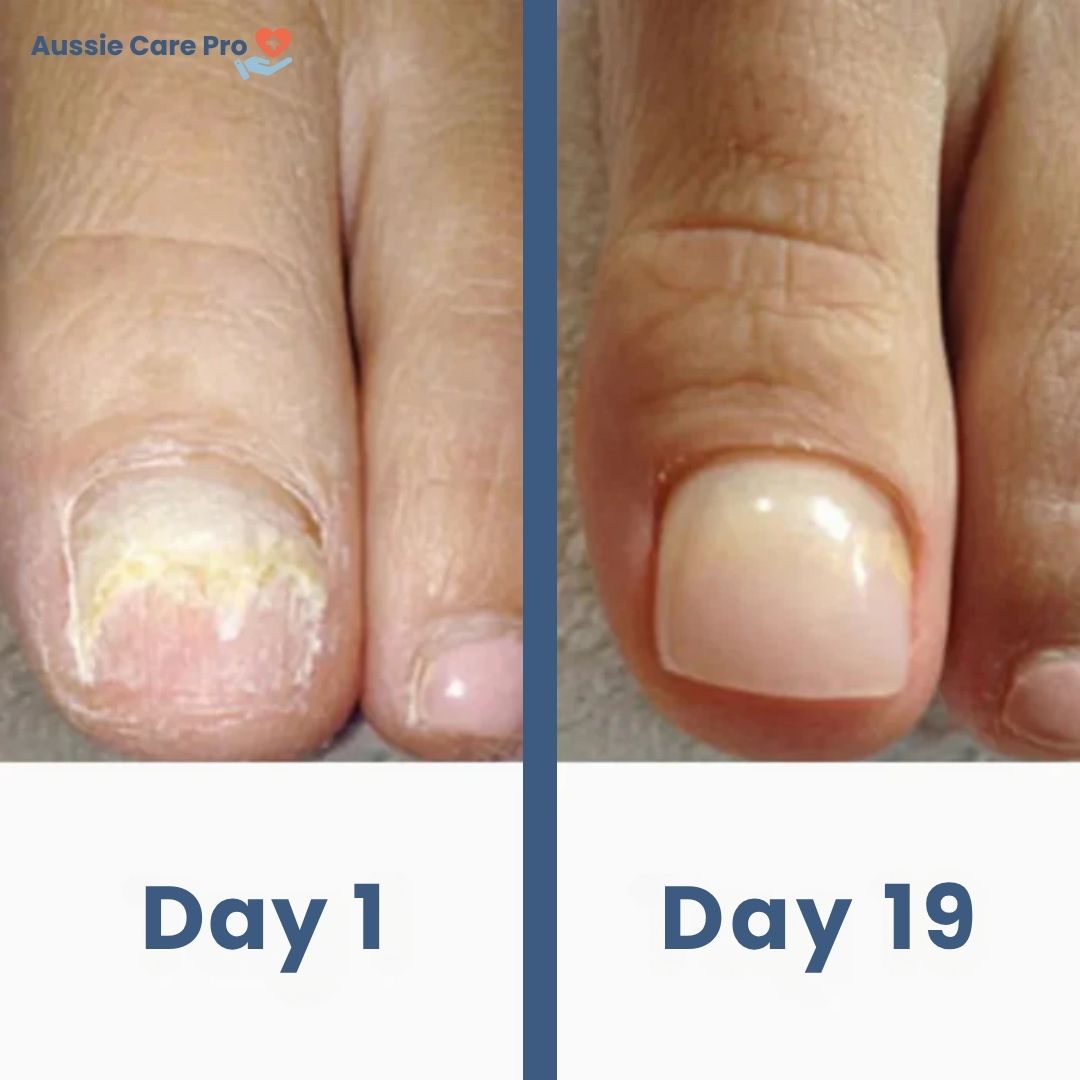 NailCare Laser Nail Fungus Treatment – Safe & Chemical-Free Therapy