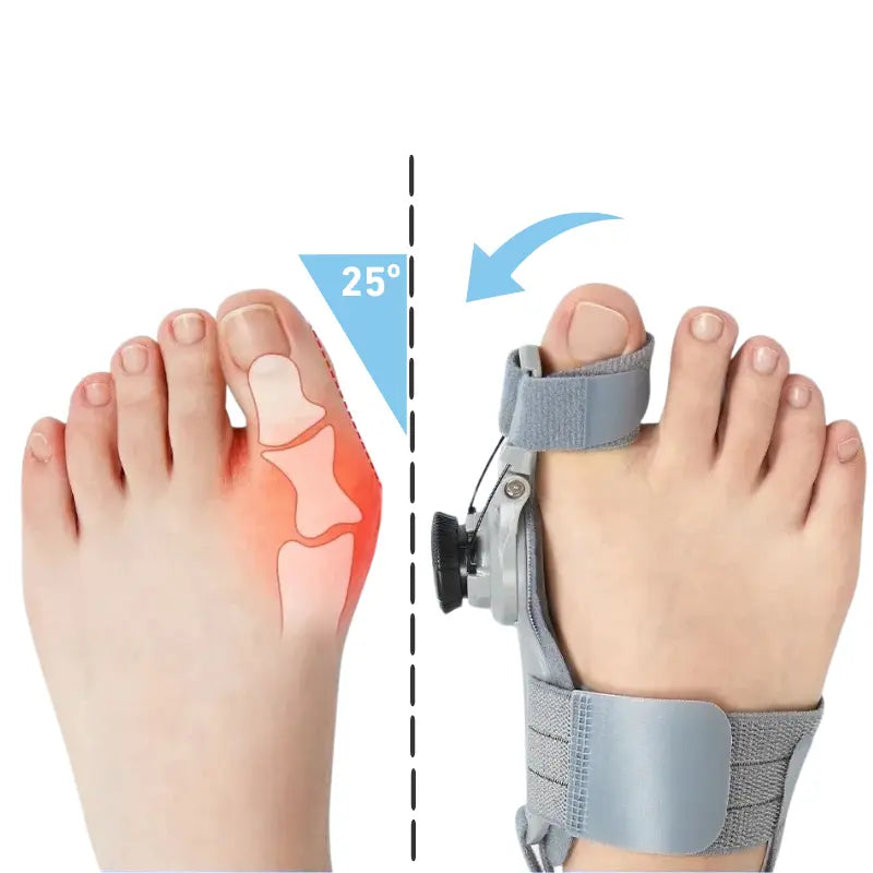 Aussie Care Pro – Hallux Corrector Brace
