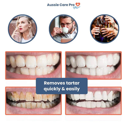 Ultrasonic Plaque & Tartar Remover – Professional Dental Cleaner for a Bright, Healthy Smile