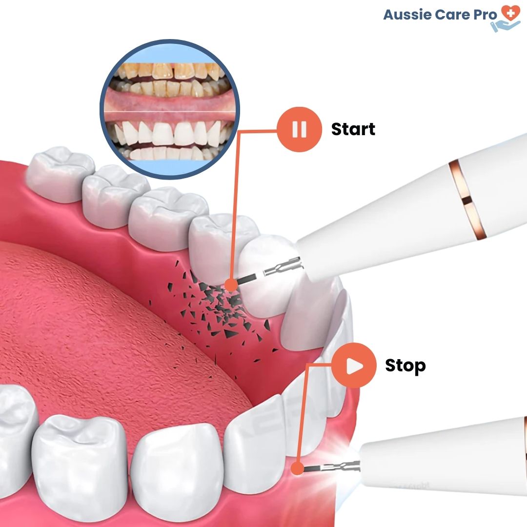Ultrasonic Plaque & Tartar Remover – Professional Dental Cleaner for a Bright, Healthy Smile
