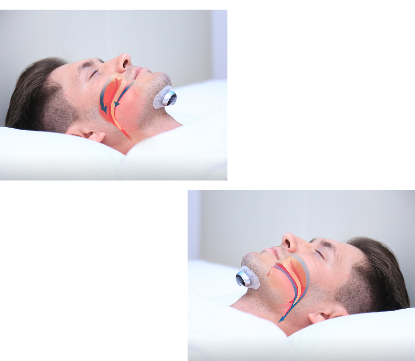 Smart Anti-Snoring Device – Wireless, Portable & App-Connected for Restful Sleep